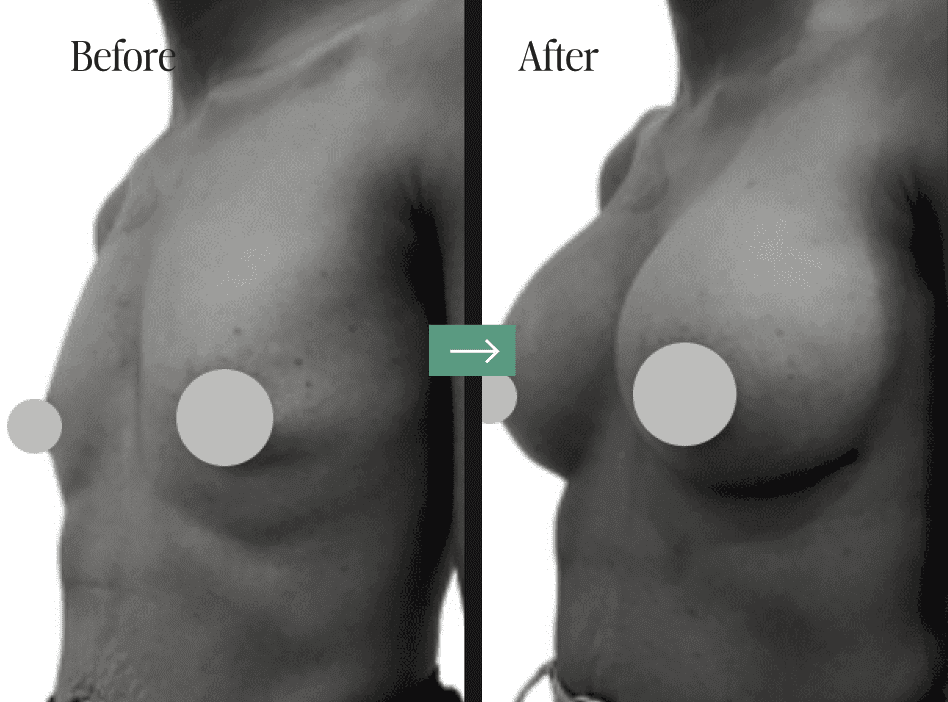 Breast Augmentation Before and After Pictures Charleston, SC